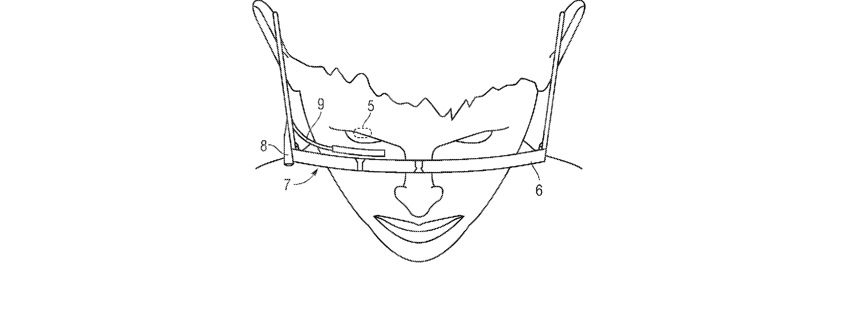 Figure for INTRAOCULAR LASER PROJECTION SYSTEM